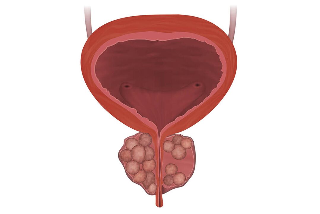 Příznaky prostatitidy